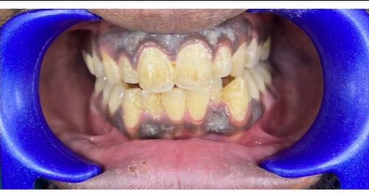 Before treatment