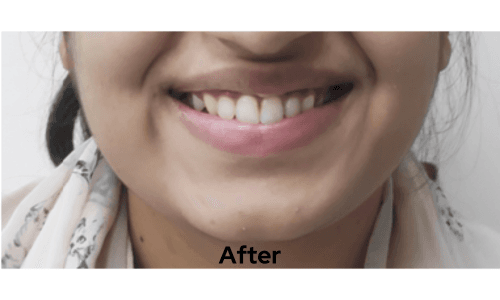 After treatment