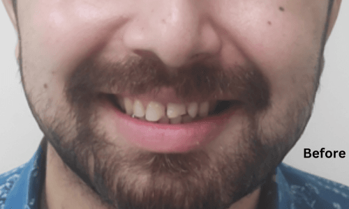 Before treatment
