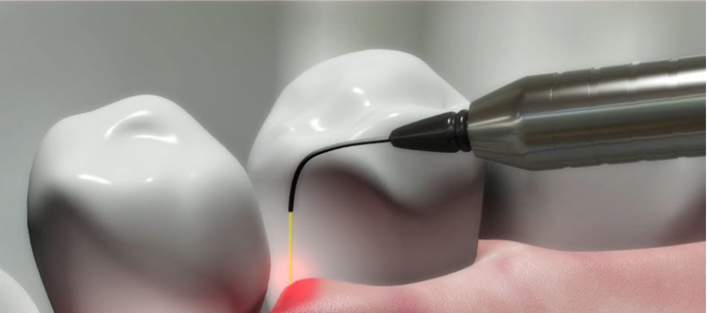Laser Dental Clinic Treatment in Indore - Bhardwaj Dental Clinic