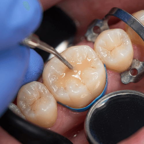 Dental Filling Treatment